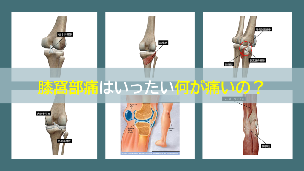 膝窩部痛はいったい何が痛いの？ 理学療法士による臨床のためのブログ