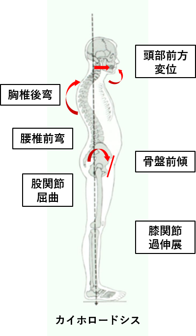 立位姿勢の分類と評価方法 理学療法士による理学療法士のためのブログ