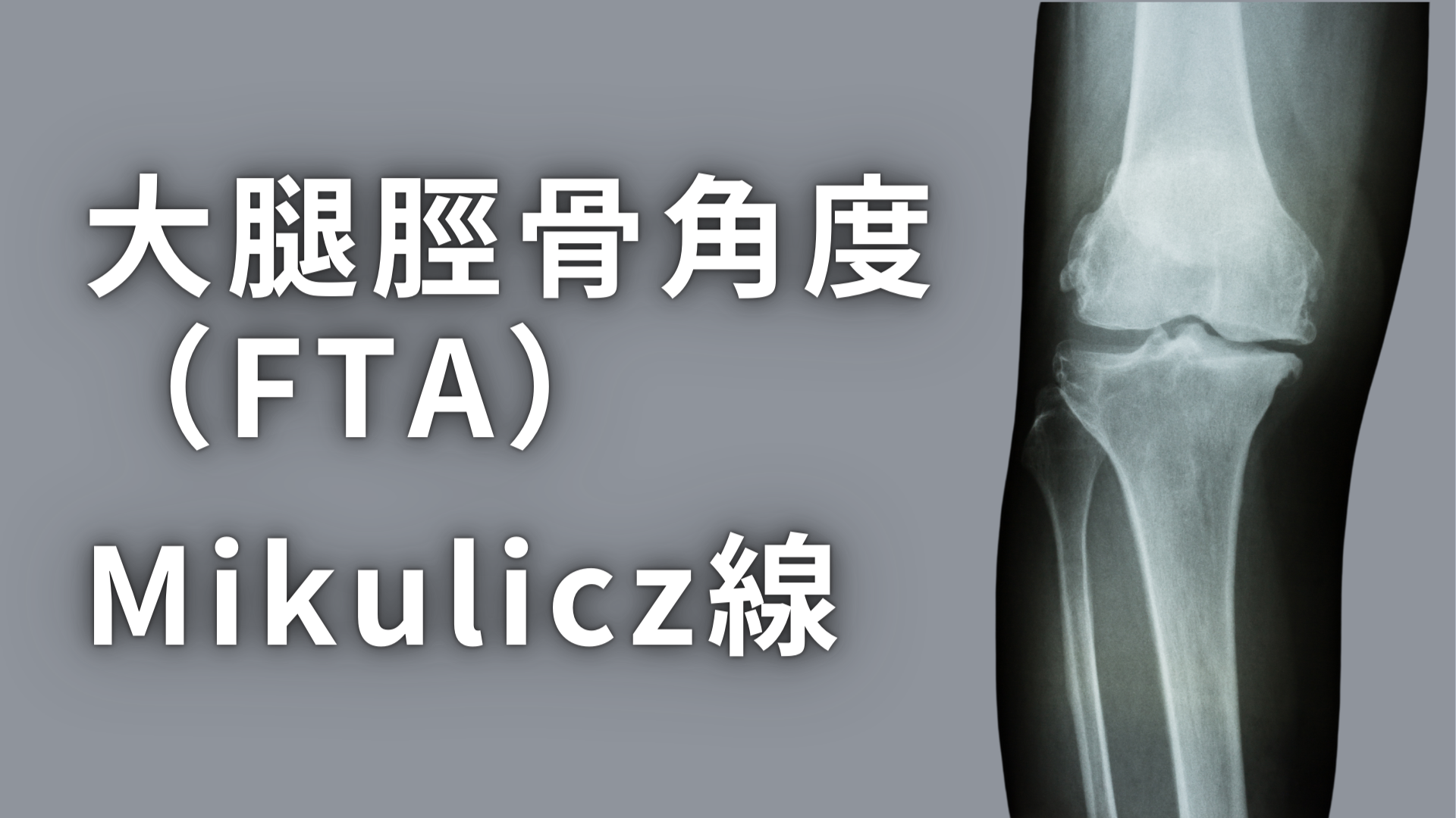 大腿脛骨角度（FTA）とMikulicz線
