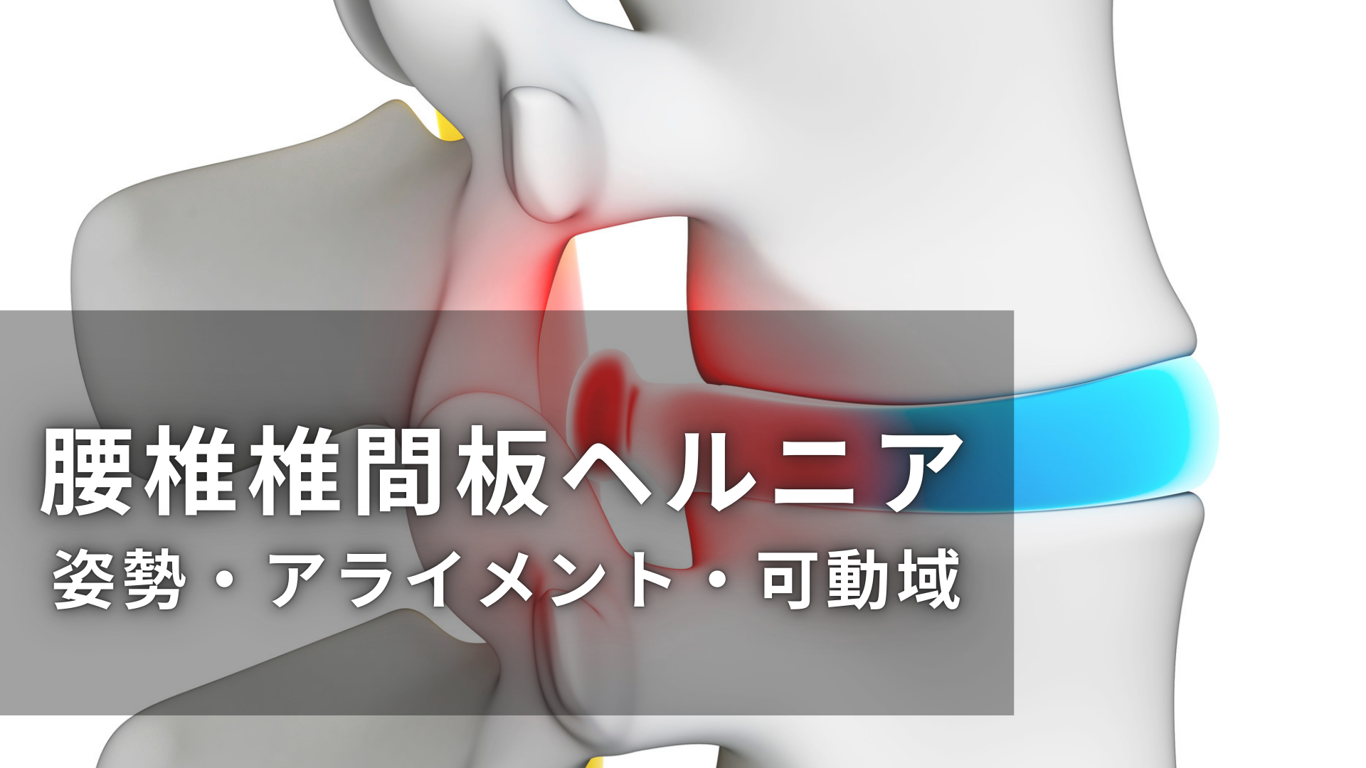 腰椎椎間板ヘルニアと姿勢・アライメント・可動域の関係