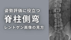 姿勢評価に役立つ脊柱側弯のレントゲン画像の見方