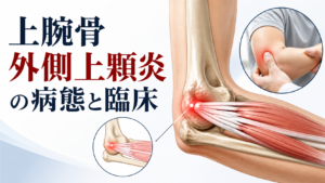 上腕骨外側上顆炎の病態と臨床