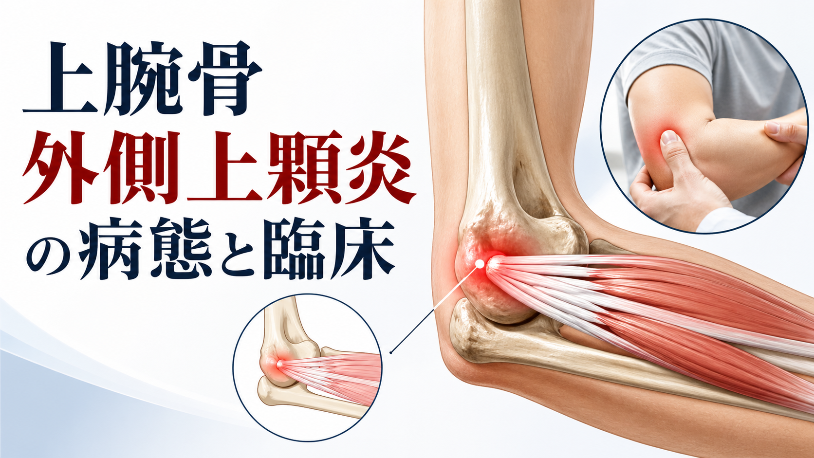 上腕骨外側上顆炎の病態と臨床
